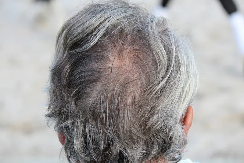 White Hair Easy Ways to Prevent It Naturally – Top Tips and Remedies